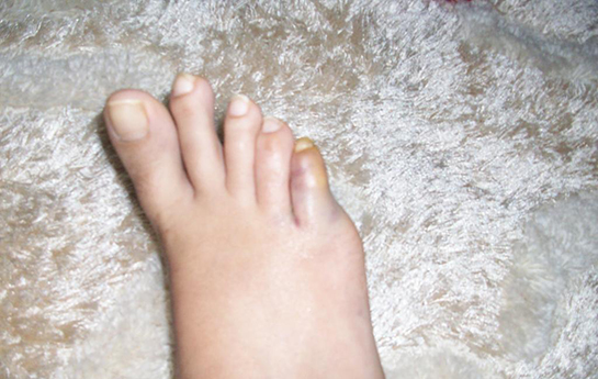 Ayak Parmağı Kırığı, Belirtileri ve Tedavisi parmak.gen.tr