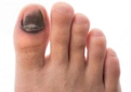 Ayak Baş Parmak Morarması Belirtileri ve Tedavisi
