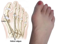 Ayak Baş Parmak Kireçlenmesi Belirtileri ve Tedavisi