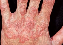 El Parmak Mantarı Belirtileri ve Tedavisi