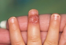 Parmakta Dolama Belirtileri ve Tedavisi