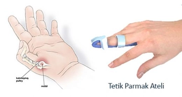 Sol El Baş Parmak Ağrısı Belirtileri ve Tedavisi