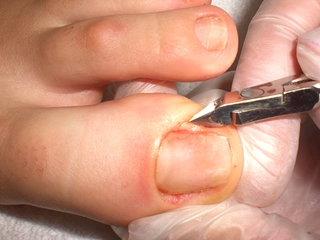 Parmak İltihabı Belirtileri ve Tedavisi